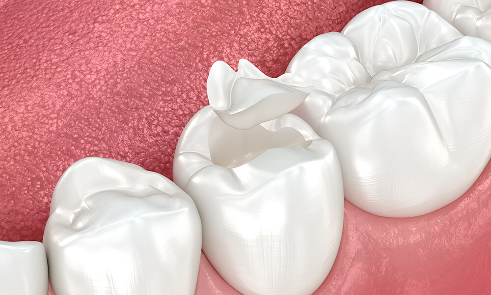 Inlays & Onlays Dentist in Hebron, KY